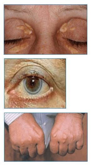 Abbasso il Colesterolo! Abbasso il Colesterolo!