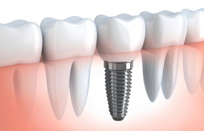 Perdere i denti senza r...impianti