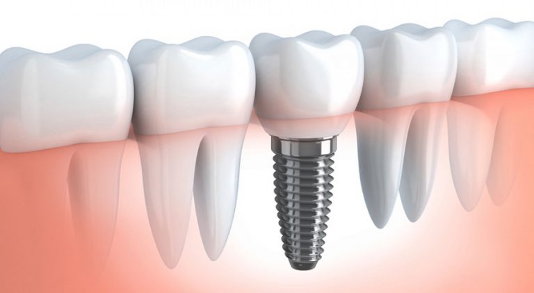 Perdere i denti senza r…impianti