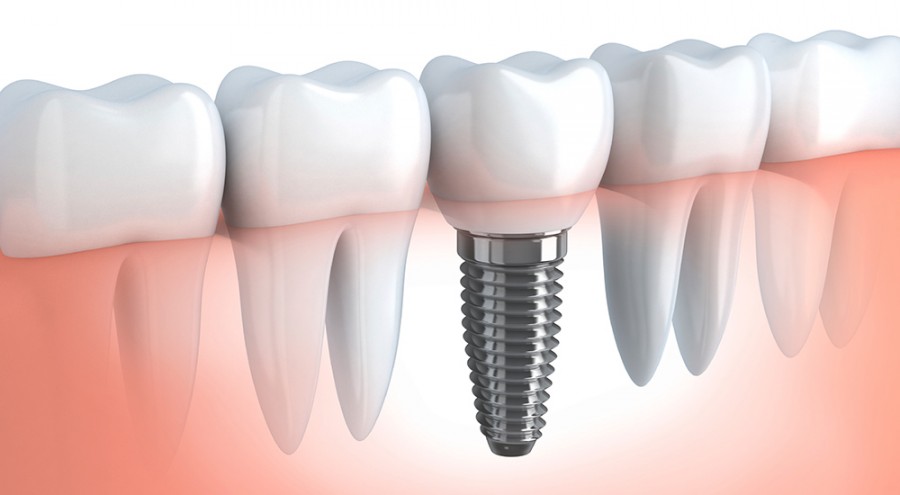 Perdere i denti senza r...impianti